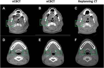 Clinical Enhancement in AI-Based Post-processed Fast-Scan Low-Dose CBCT for Head and Neck Adaptive Radiotherapy
